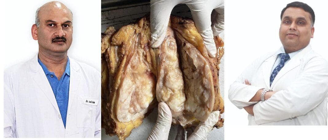 फिम्स अस्पताल की टीम द्वारा स्तन कैंसर ट्यूमर की सफल सर्जरी