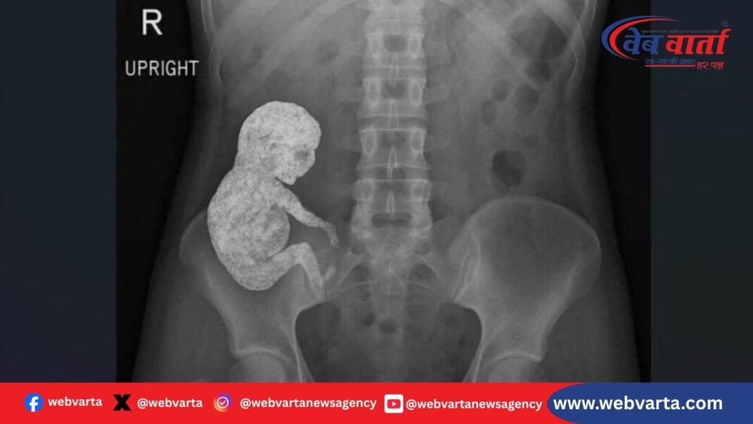 लिथोपेडियन स्टोन बेबी मेडिकल इलस्ट्रेशन और एक्स-रे